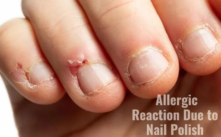 How to Treat an Allergic Reaction to Gel Nail Polish?